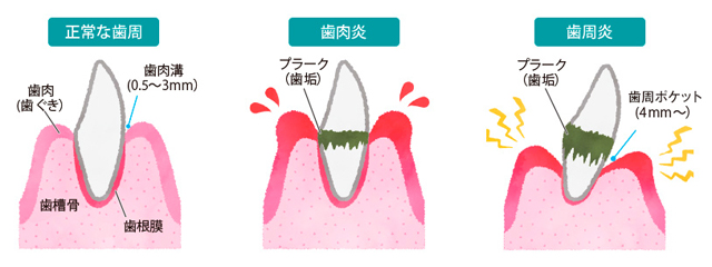 ▲歯周病には、歯ぐきが炎症を起こし腫れる「歯肉炎」と、歯肉炎の放置により症状が進行し、歯を支える骨が溶けた状態の「歯周炎」の2つの段階があります。