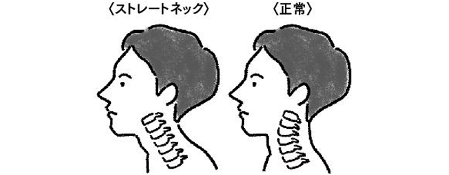 ストレートネック