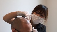 【斬新すぎる薄毛治療】カツラとも植毛とも違う新しい薄毛治療「メディカルSMP」日本上陸